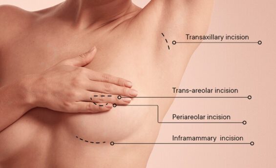 POLYTECH_Website_Incision_Content-1